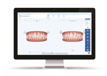 Align Technology Expands Digital Platform with Cloud-Based ClinCheck™ Pro 6.0 and ClinCheck “In-Face” Visualization for Invisalign Treatment